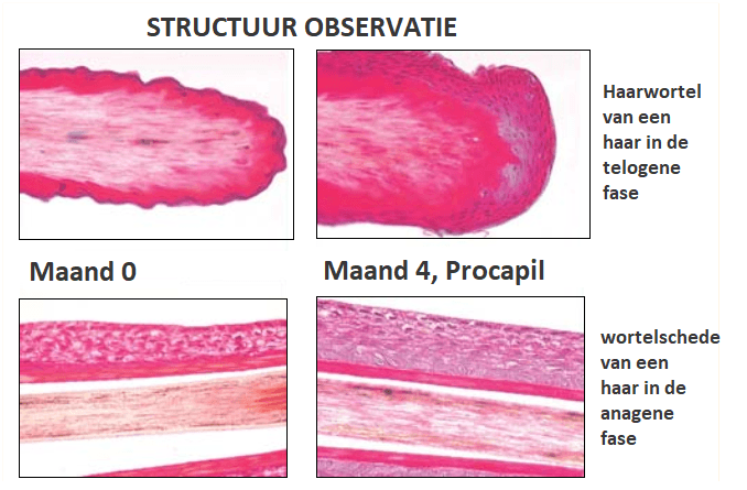 haarwortel voor en na procapil